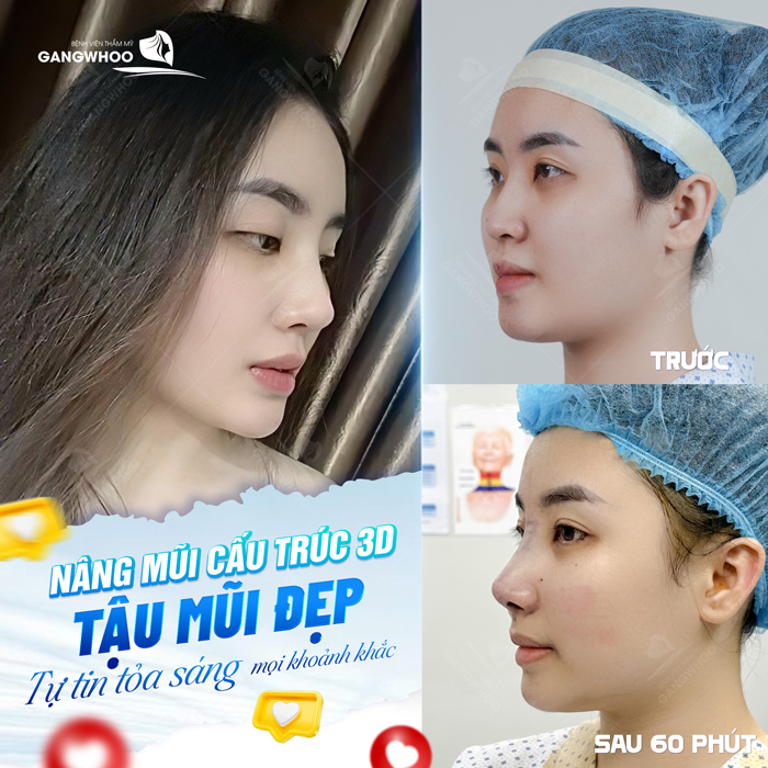 Có cách nào nâng mũi tại nhà hiệu quả và an toàn mà không cần phẫu thuật không?