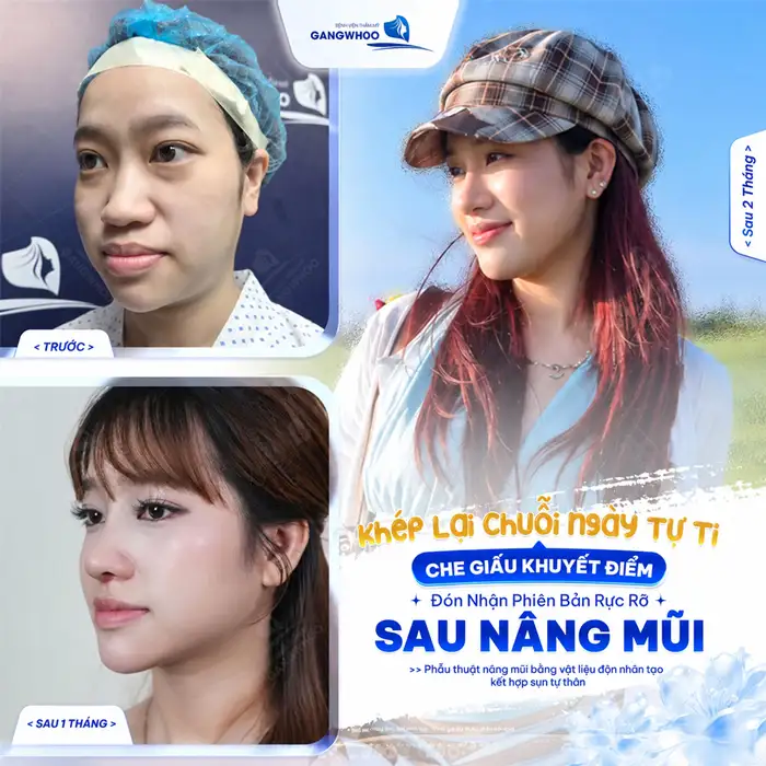Nâng Mũi Bọc Sụn – Giải Pháp Cho Dáng Mũi Đẹp Tự Nhiên, An Toàn 1 Nâng Mũi Bọc Sụn – Giải Pháp Cho Dáng Mũi Đẹp Tự Nhiên, An Toàn