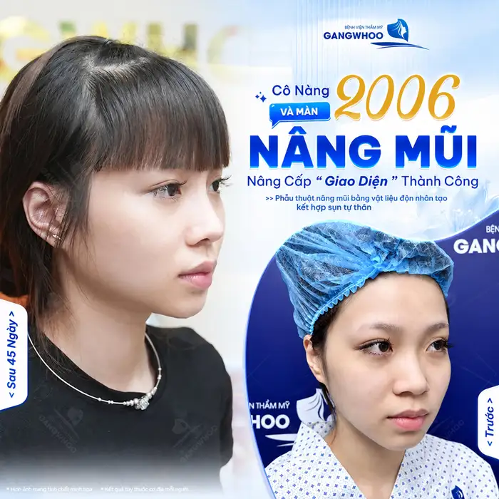 Nâng Mũi Hàn Quốc – Công Nghệ Chuẩn Hàn, An Toàn & Tự Nhiên