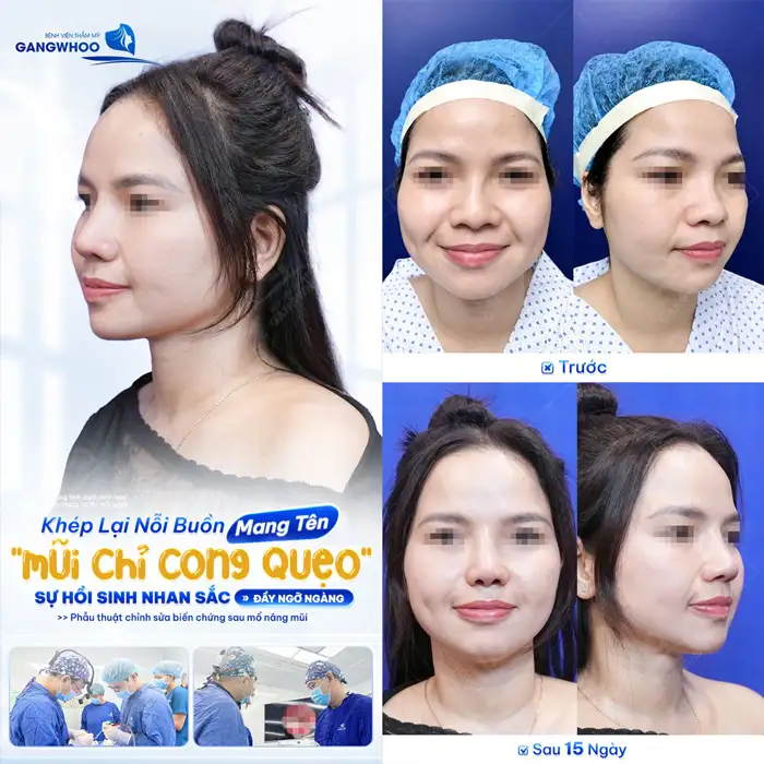 Sửa Mũi Hỏng – Khôi Phục Dáng Mũi Đẹp, Tự Nhiên, An Toàn