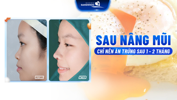 Sau nâng mũi ăn trứng được không? Ăn trứng có bị sẹo lồi hay thâm mũi không?