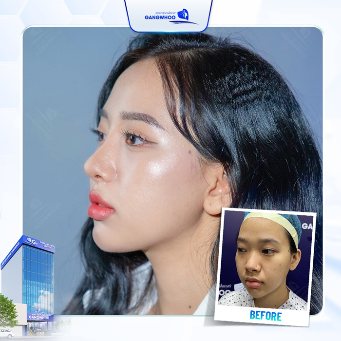 Bác sĩ giải đáp nâng mũi bao lâu thì đầu mũi hết to