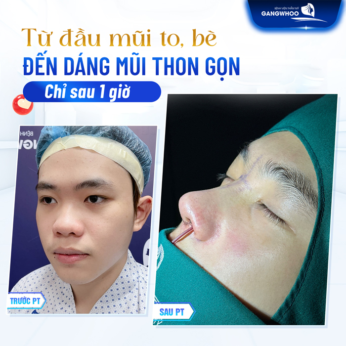 Bác sĩ giải đáp nâng mũi bao lâu thì đầu mũi hết to