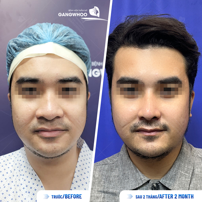 Bác sĩ giải đáp nâng mũi bao lâu thì đầu mũi hết to