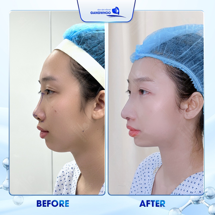 Nâng mũi cấu trúc 4D Nanoform là gì? Có ưu điểm gì nổi bật?