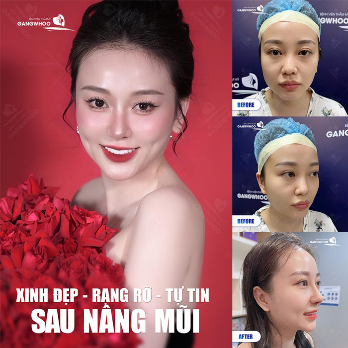 Nâng mũi cấu trúc 4D Nanoform là gì? Có ưu điểm gì nổi bật?