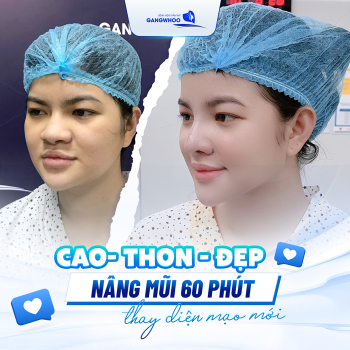 Nâng mũi chỉ collagen là gì? Có an toàn không?