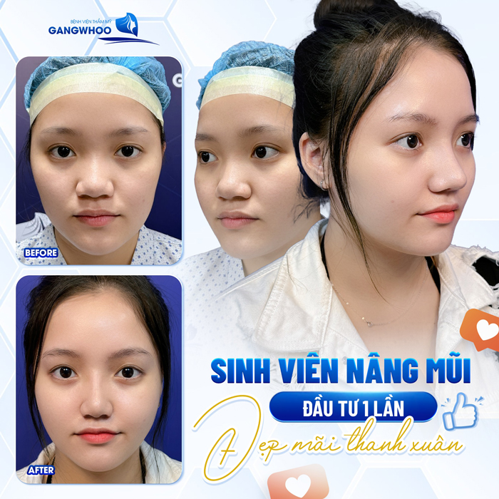 Nâng mũi chỉ collagen là gì? Có an toàn không?