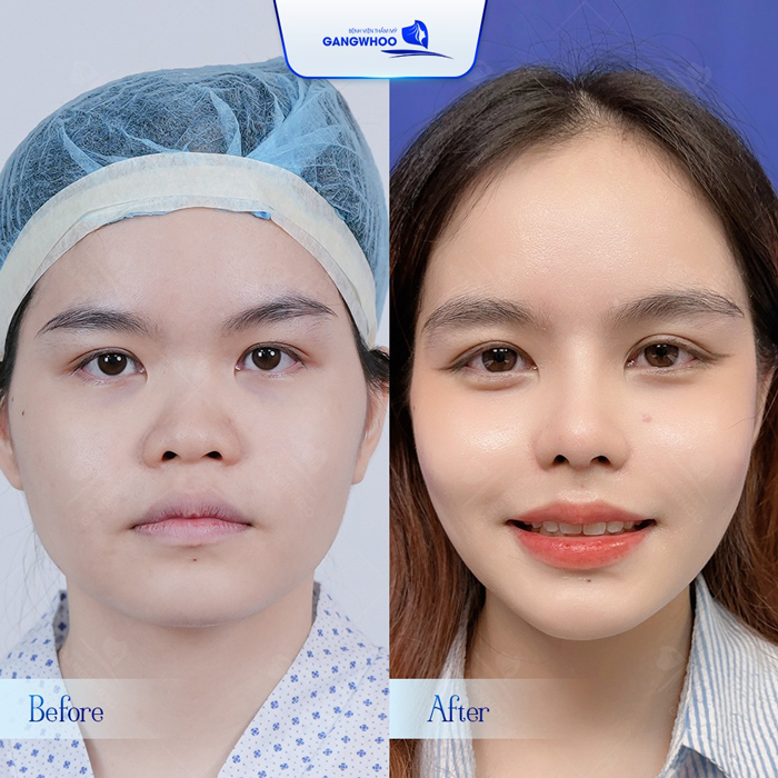 Nâng mũi chỉ collagen là gì? Có an toàn không?