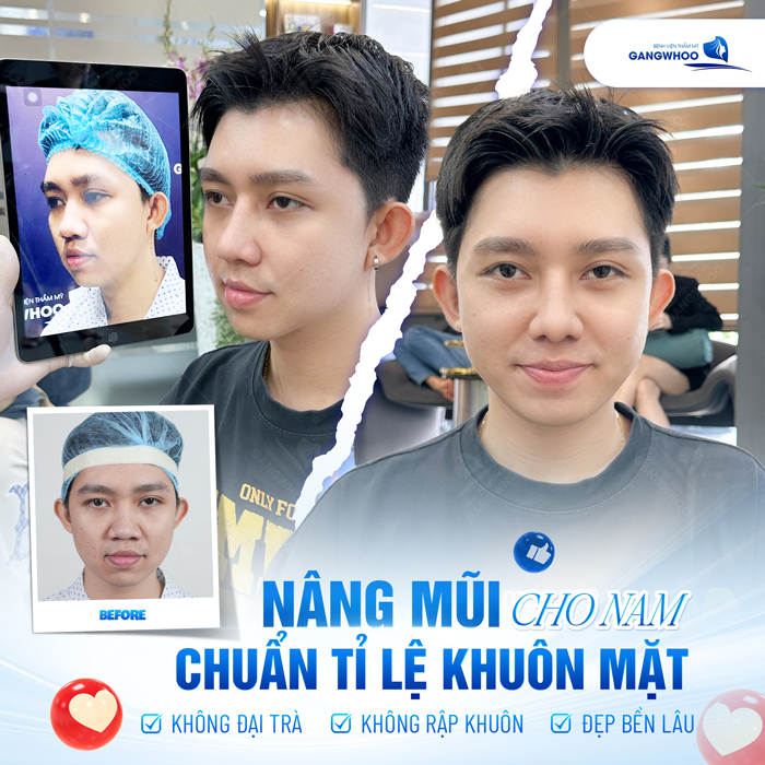 Giải đáp nâng mũi cho nam giới có gì khác biệt so với nữ