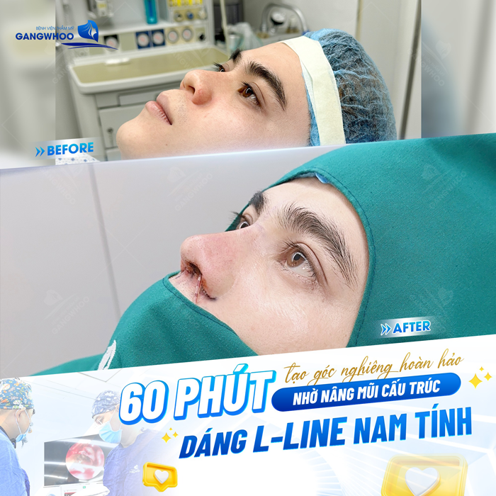 Giải đáp nâng mũi cho nam giới có gì khác biệt so với nữ