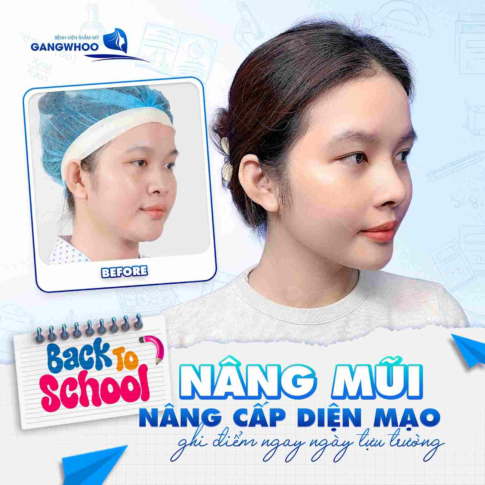 Tìm hiểu về phương pháp nâng mũi Hàn Quốc là gì?