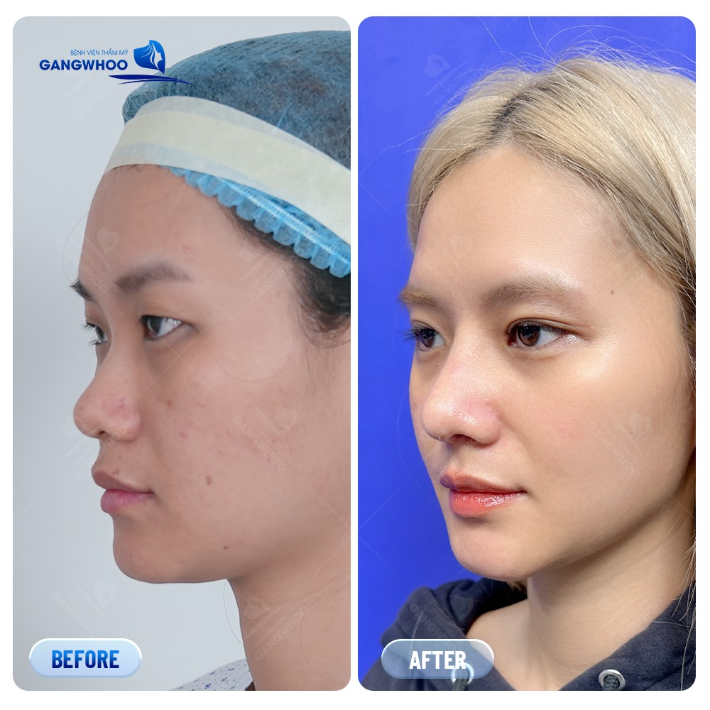 Hình ảnh khách hàng trước và sau khi nâng mũi