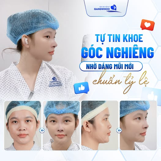 Tạo dáng mũi đẹp tự nhiên, cân đối gương mặt