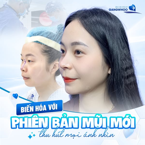Phương pháp nâng mũi bằng chỉ sinh học 