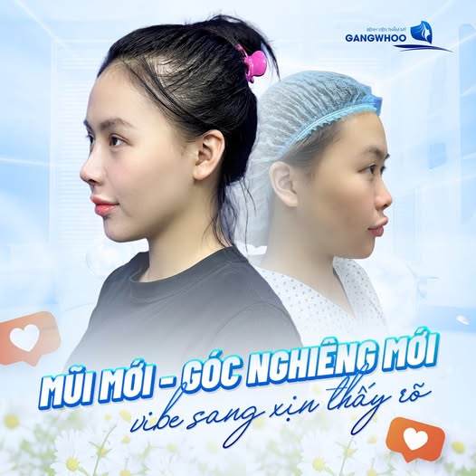 Nâng mũi sau bao lâu thì ổn định?