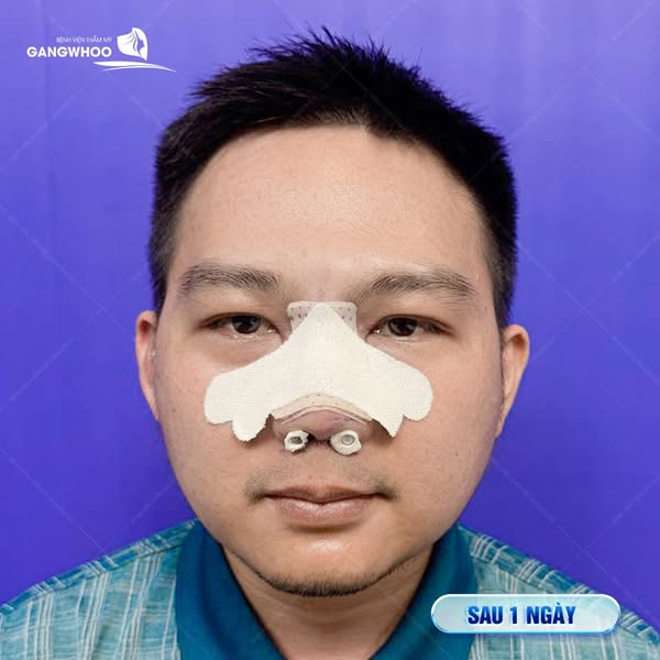 Các giai đoạn hồi phục sau khi nâng mũi