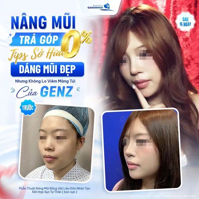 Nâng Mũi Trả Góp Lãi Suất 0% – An Tâm Làm Đẹp, Chi Phí Thấp