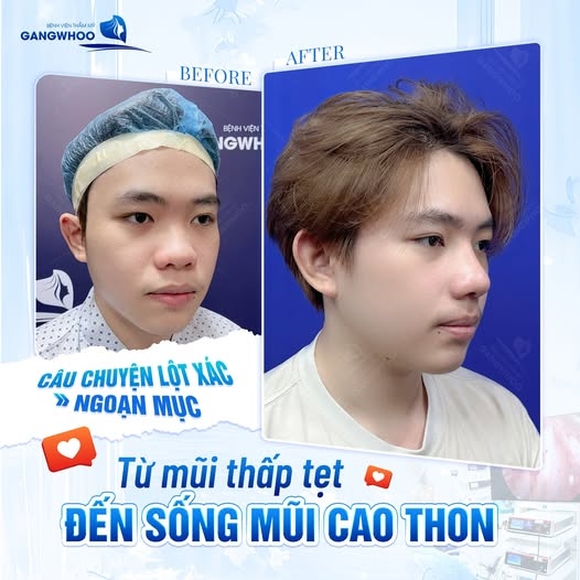 Nâng mũi trả góp có được không?