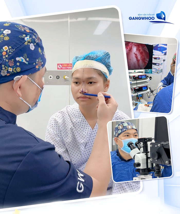 Bí quyết nâng mũi tự nhiên tại nhà an toàn