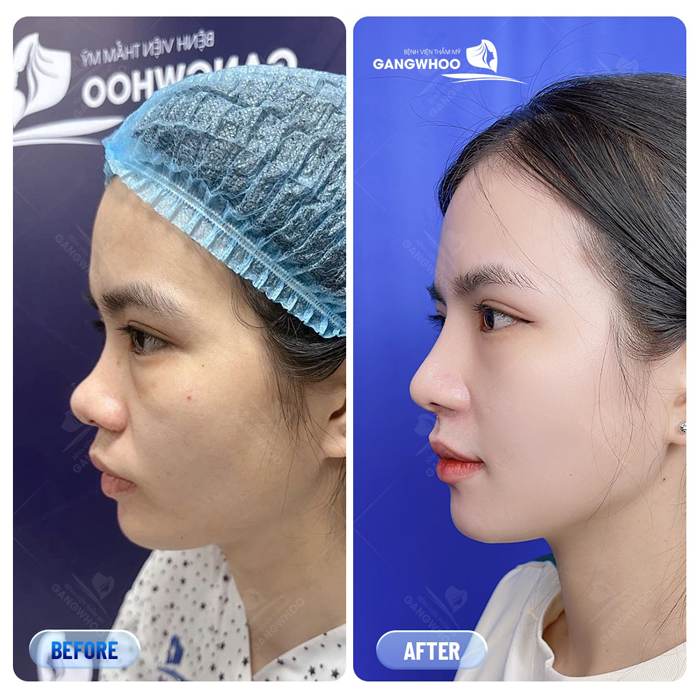 Bí quyết nâng mũi tự nhiên tại nhà an toàn