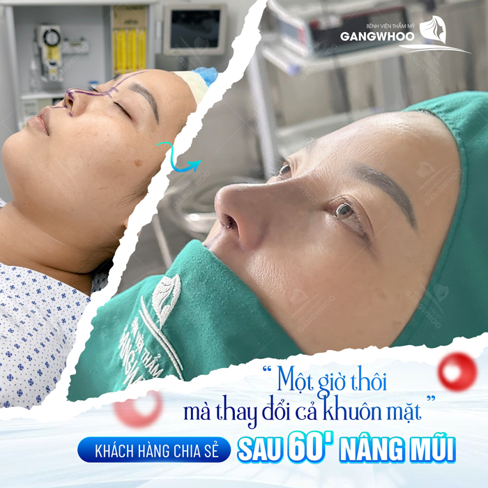 Bí quyết nâng mũi tự nhiên tại nhà an toàn