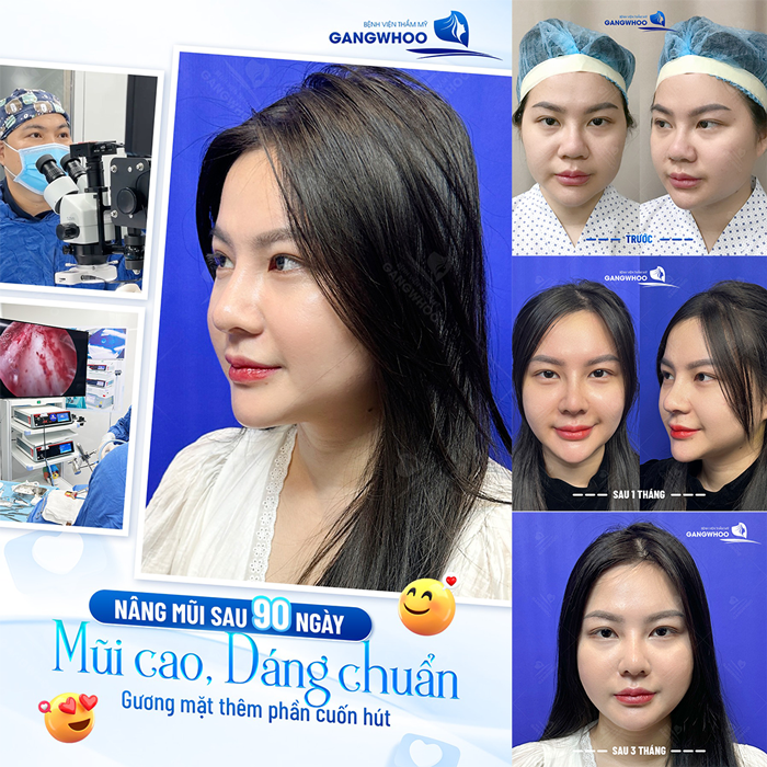 Bí quyết nâng mũi tự nhiên tại nhà an toàn