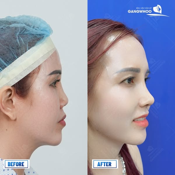 Review nâng mũi tại bệnh viện thẩm mỹ Gangwhoo