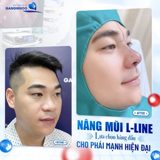 Review nâng mũi tại bệnh viện thẩm mỹ Gangwhoo