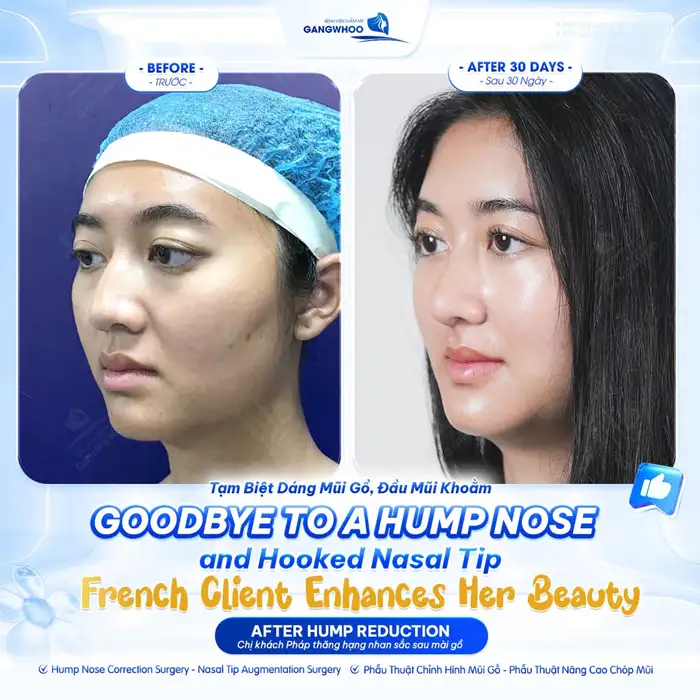 Mài Gồ Xương Mũi – Chỉnh Sửa Gồ Xương, Sở Hữu Sống Mũi Thẳng, Đẹp