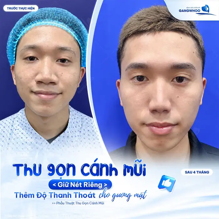 Thu Gọn Cánh Mũi – Giải Pháp Tạo Cánh Mũi Cân Đối, Thanh Thoát Tự Nhiên