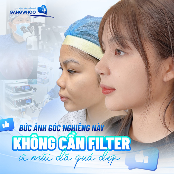 Tiêm filler nâng mũi có an toàn không, duy trì được bao lâu và có bị biến chứng không?