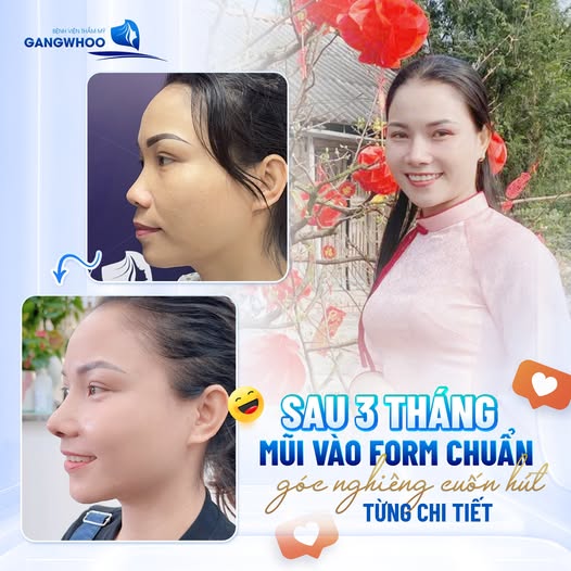 Hình ảnh khách hàng trước và sau khi nâng mũi