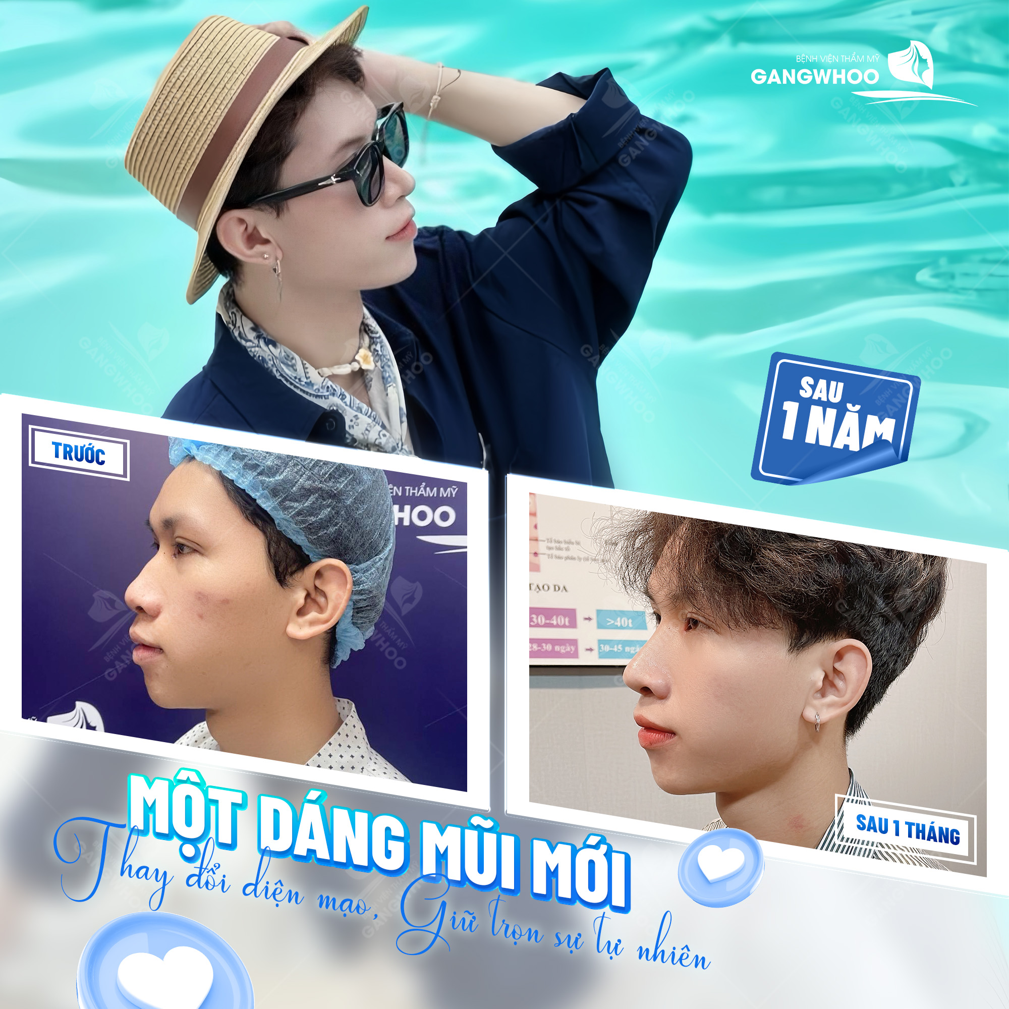 Hình ảnh khách hàng trước và sau khi nâng mũi