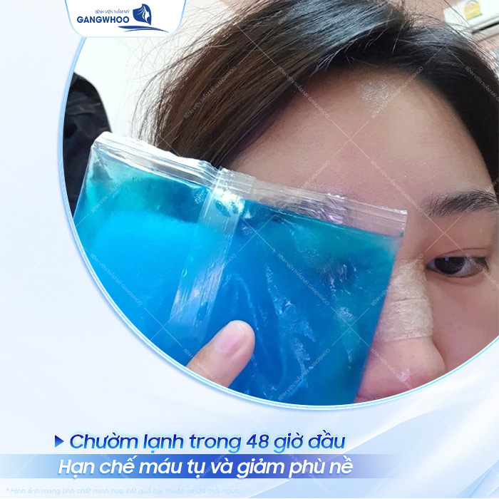 Cách giảm sưng sau nâng mũi nào hiệu quả? Cần lưu ý gì để tránh tình trạng bị sưng sau nâng mũi