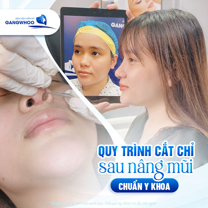 Cắt chỉ nâng mũi có đau không? Quy trình cắt chỉ sau nâng mũi như thế nào?