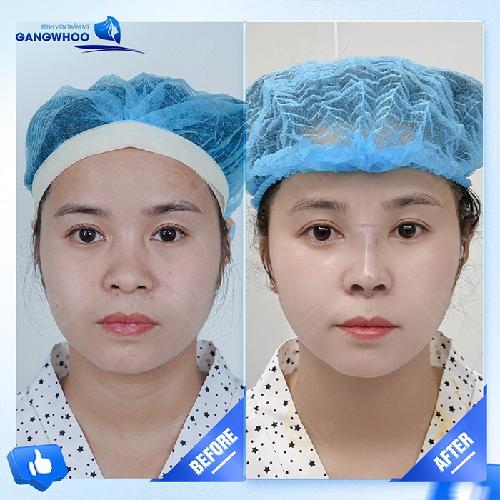 Da mũi mỏng có nâng mũi được không và cần lưu ý gì?