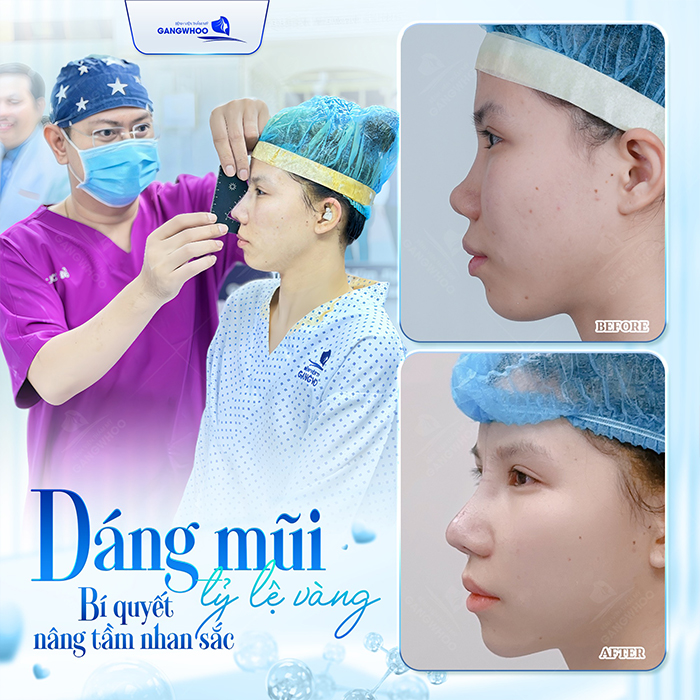 Da mũi mỏng có nâng mũi được không và cần lưu ý gì?