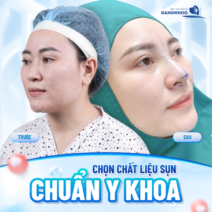 Dấu hiệu dị ứng chất liệu khi nâng mũi là gì? Cần xử lý như thế nào?