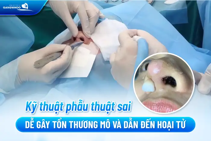 Dấu hiệu nâng mũi bị hoại tử như thế nào? Cách xử lý như thế nào?