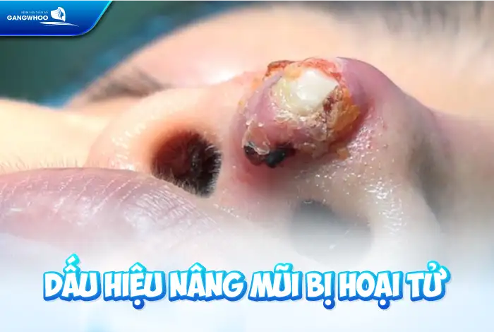 Dấu hiệu nâng mũi bị hoại tử như thế nào? Cách xử lý như thế nào?