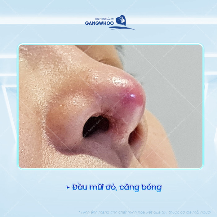 Các dấu hiệu nhận biết mũi tụt sụn sau nâng là gì? Cách xử lý như thế nào?