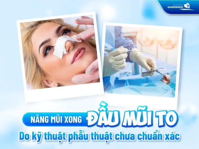 Đầu Mũi To Sau Khi Nâng Mũi Bao Lâu Thì Bình Thường?