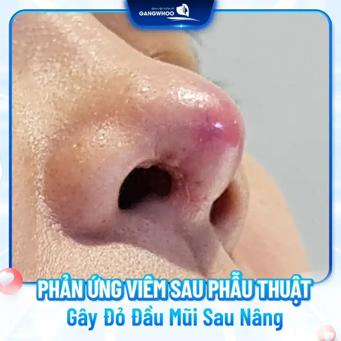 Nguyên nhân đỏ đầu mũi sau khi nâng là gì? Cách xử lý như thế nào?
