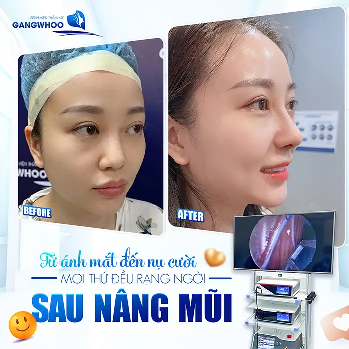 Dụng cụ nâng mũi của Nhật có tốt không? Có nên sử dụng để nâng mũi