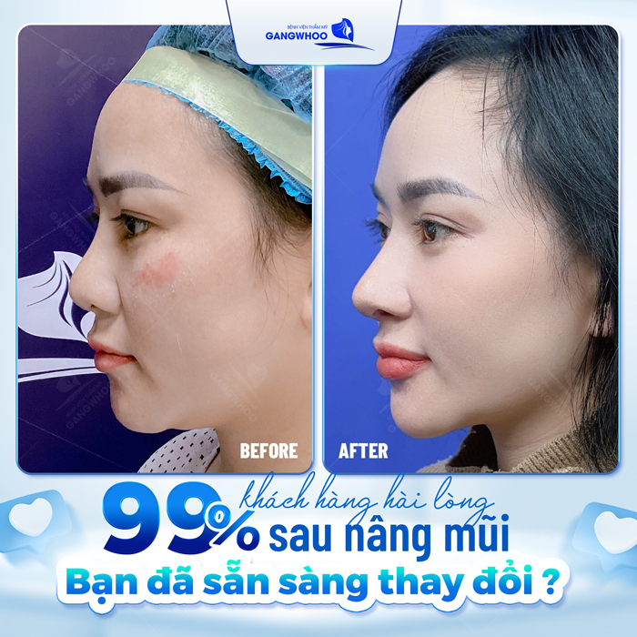 Giá nâng mũi S line 3D hiện nay là bao nhiêu? Các yếu tố ảnh hưởng đến giá là gì?