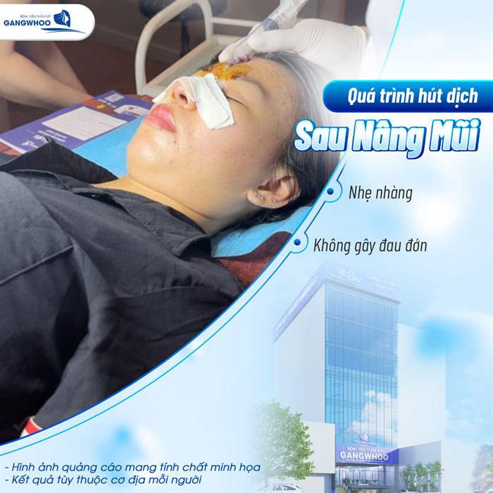 Hút dịch sau nâng mũi có đau không và cần lưu ý gì? 1 Hút dịch sau nâng mũi có đau không và cần lưu ý gì?