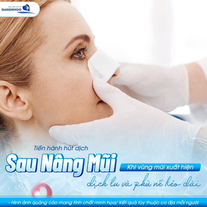 Hút dịch sau nâng mũi có đau không và cần lưu ý gì? 2 Hút dịch sau nâng mũi có đau không và cần lưu ý gì?