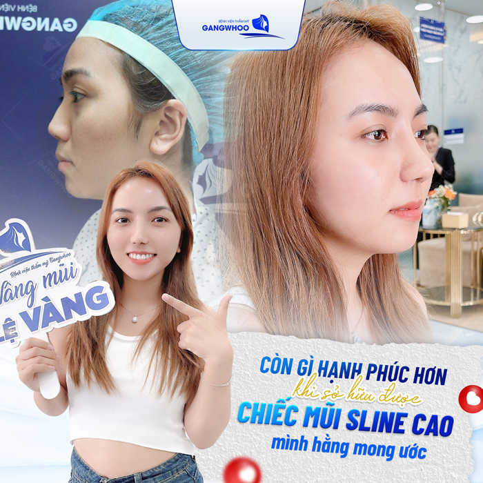 Kỹ thuật nâng mũi mới nhất hiện nay là gì? Có nên lựa chọn không?