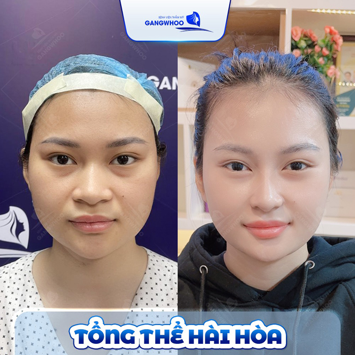 Mặt tròn nên nâng mũi gì thì phù hợp nhất?